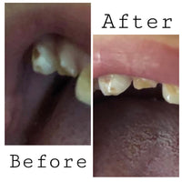 *NEW* Remineralizing Tooth Puddy (Spot Treatment)