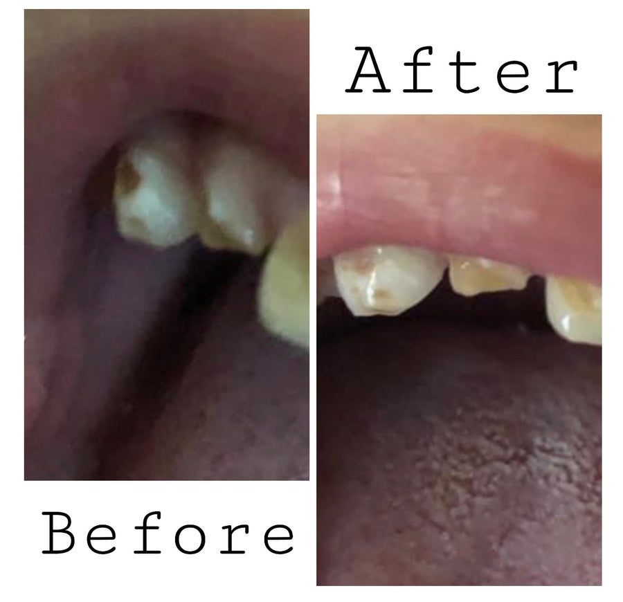 *NEW* Remineralizing Tooth Puddy (Spot Treatment)
